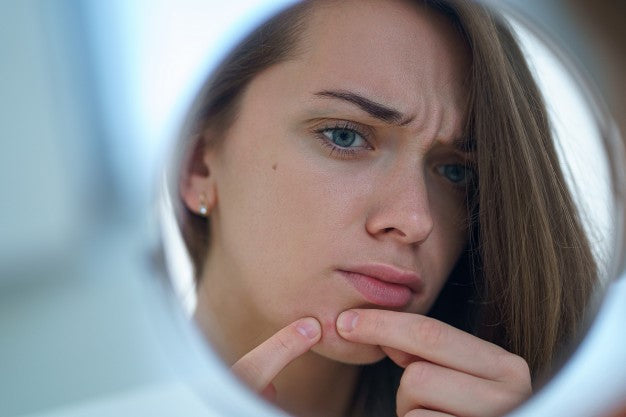 Is Organic Apple Cider Vinegar Useful For Acne?